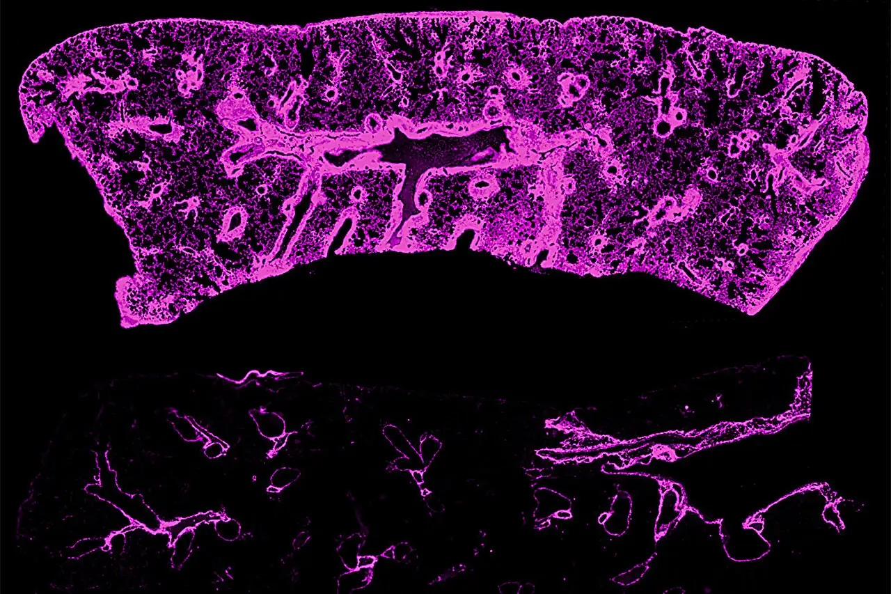 Lymphatic Disruption Triggers Chronic Rejection in Transplanted Lungs and Hearts